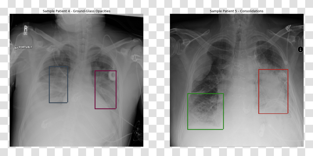 Pneumonia Detection, X-Ray, Medical Imaging X-Ray Film, Ct Scan Transparent Png