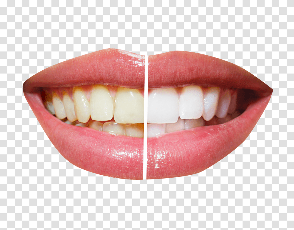 Teeth Whitening Image, Person, Mouth, Lip, Egg Transparent Png