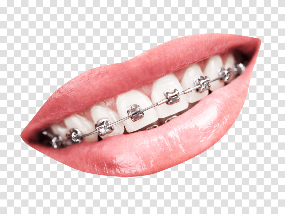 Teeth With Braces Image, Person, Mouth, Lip, Human Transparent Png