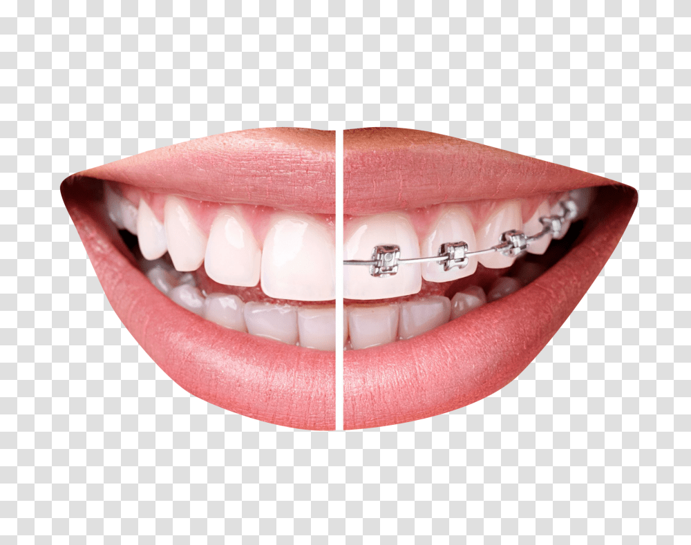 Teeth With Braces Image, Person, Mouth, Lip Transparent Png