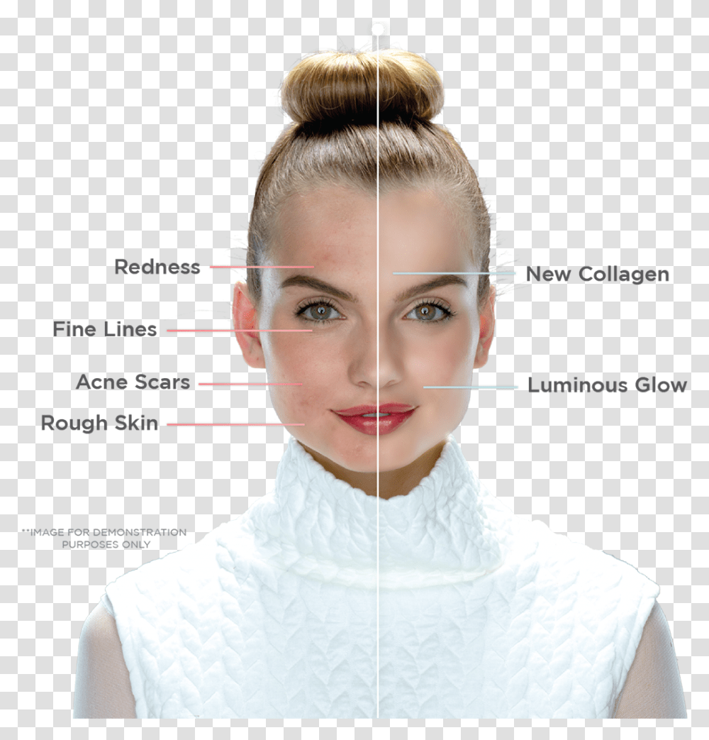 Portrait Photo With Left Side Of Face Before Treatment Laser Facial Treatment, Person, Hair, Female, Head Transparent Png