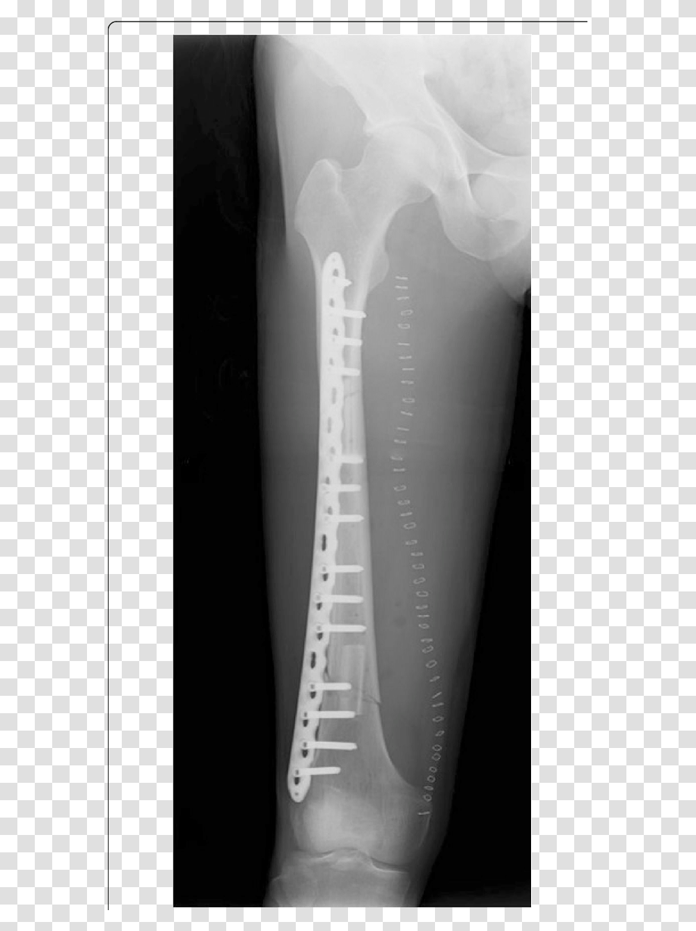 Postoperative Radiography After The Femur Reconstruction X Ray, X-Ray, Ct Scan, Medical Imaging X-Ray Film Transparent Png