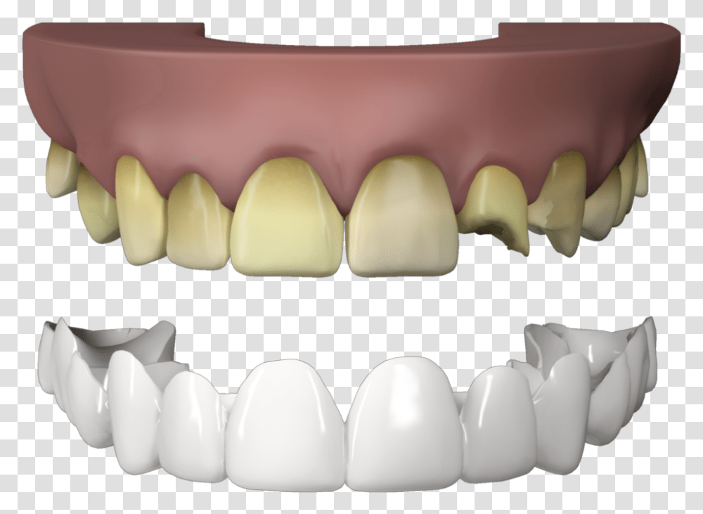 Press On Veneers Teeth Fang, Mouth, Lip, Jaw Transparent Png
