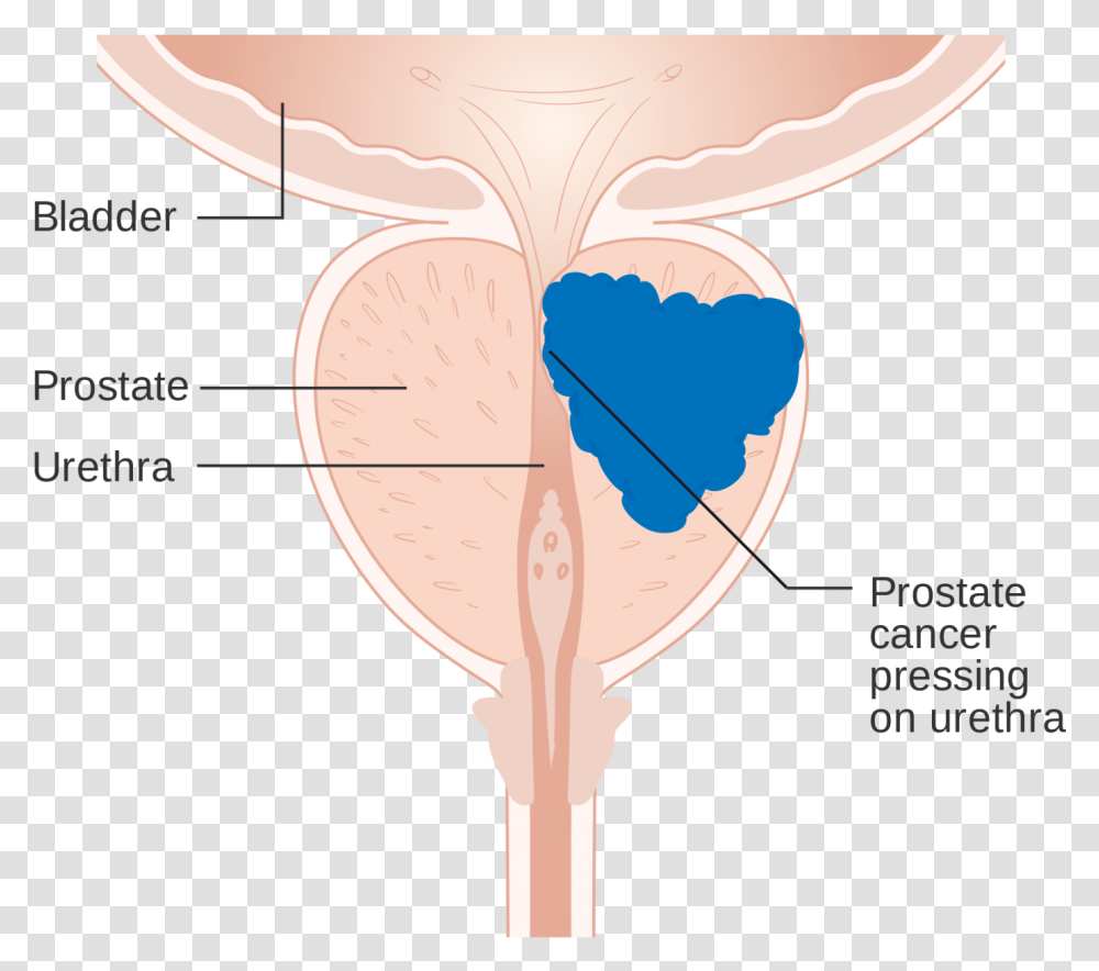 Prostate Cancer DiagramClass Img Responsive Lazyload, Mouth, Sweets, Food, Lollipop Transparent Png