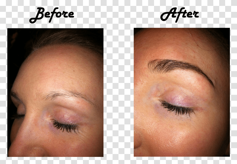 Prp Treatment For Eyebrows Download, Skin, Face, Person, Human Transparent Png