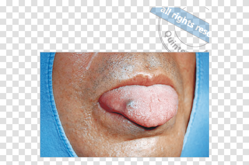 Purple Lump In Tongue, Mouth, Lip, Person, Human Transparent Png