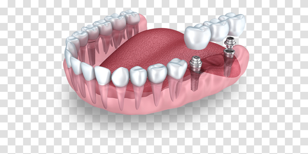 Q And M Home Dental Implant Missing Teeth Much It Cost A Dental Crown, Jaw, Mouth, Lip, Birthday Cake Transparent Png