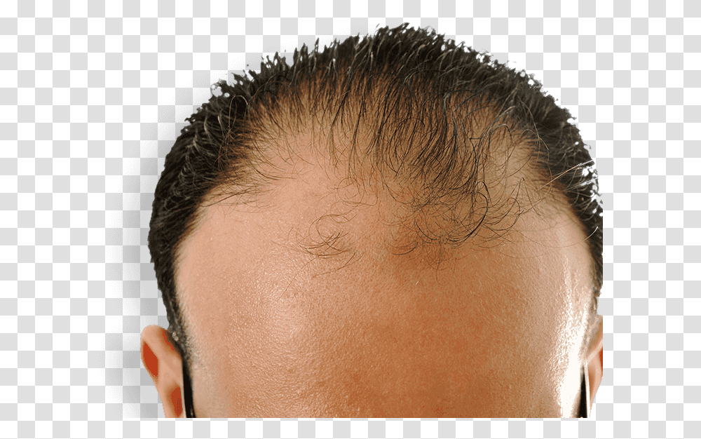 Receding Hairline Will Castor Oil Regrow Hair, Head, Skin, Face, Person Transparent Png