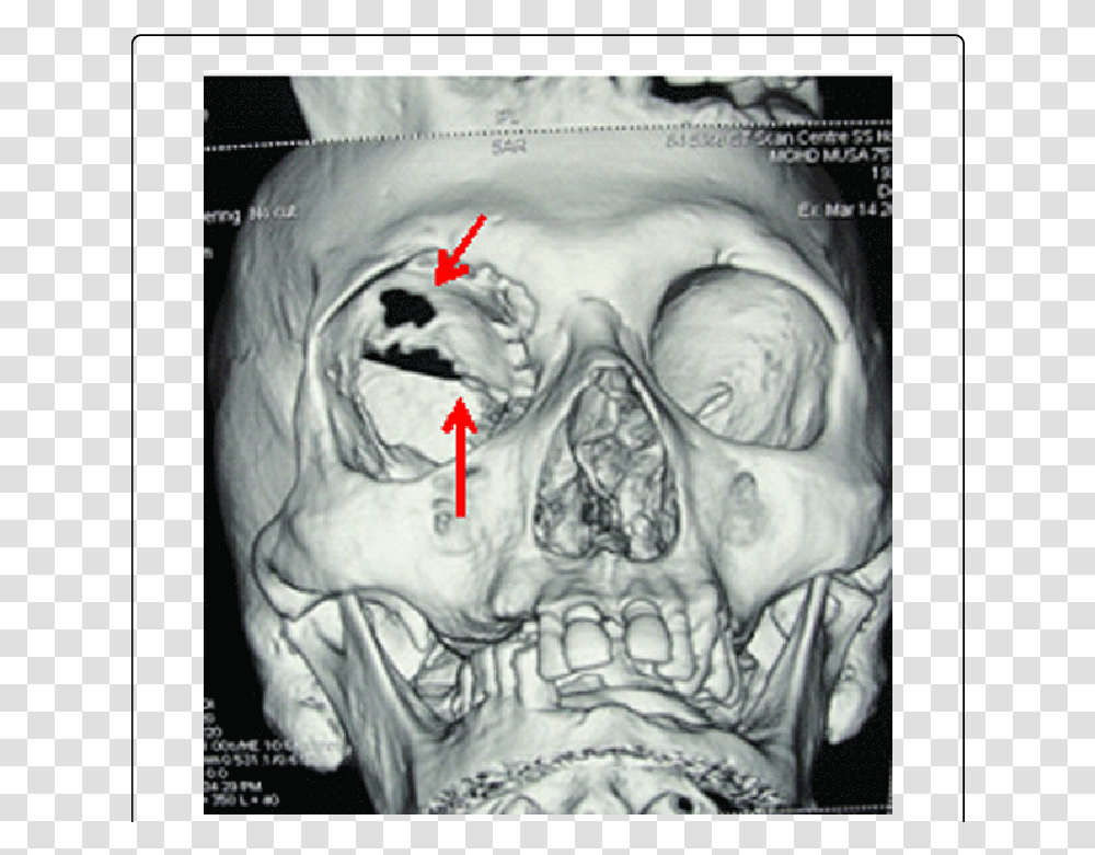 Red Right Arrow, X-Ray, Ct Scan, Medical Imaging X-Ray Film, Tattoo Transparent Png