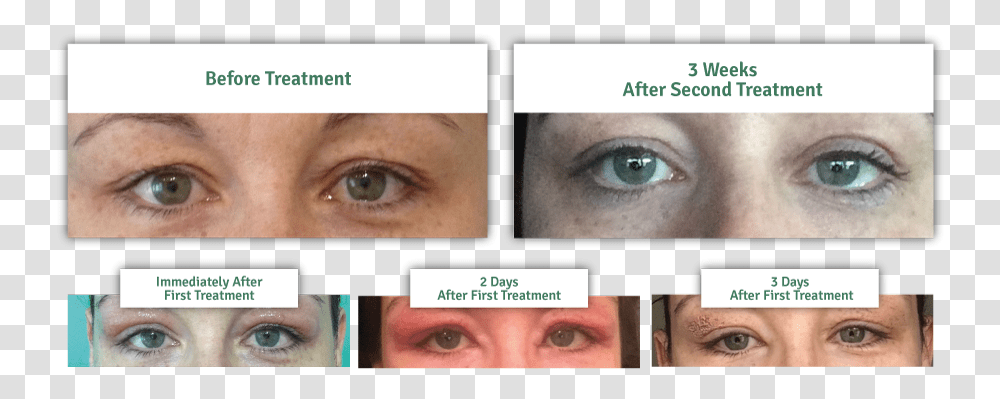 Results Of A Non Surgical Eye Lift Plasma Iq Eye Lift, Face, Person, Head, Collage Transparent Png