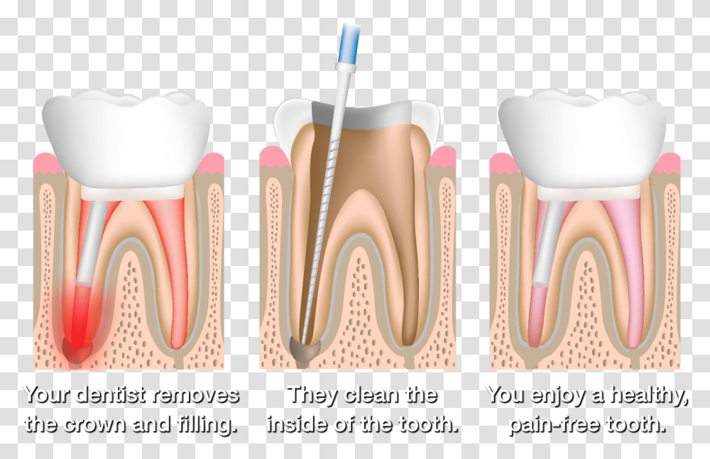 Root Canal Therapy, Teeth, Mouth, Lip, Jaw Transparent Png
