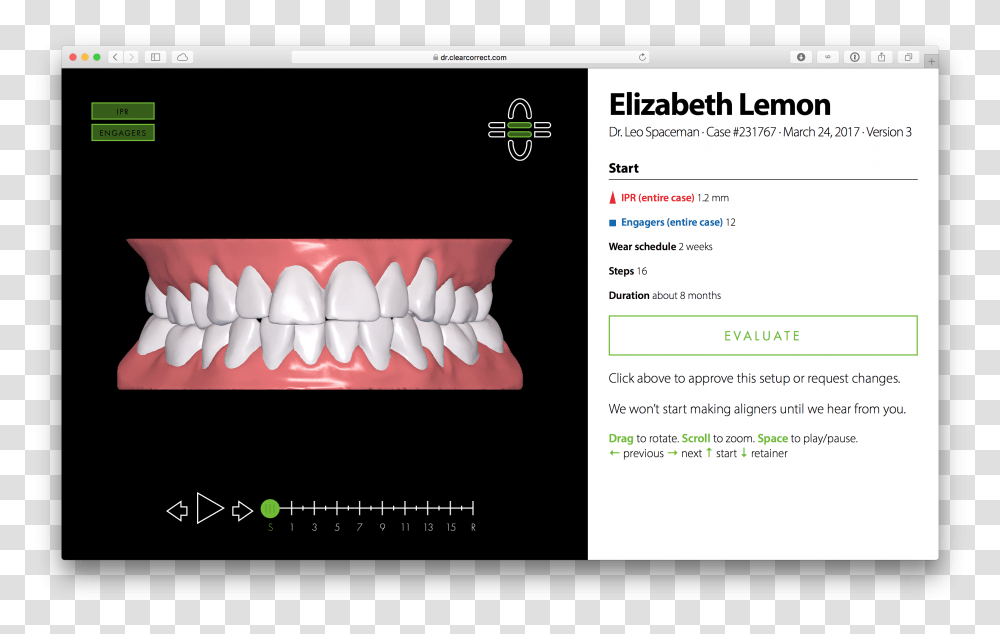 Screen Shot 2017 06 14 At Clear Correct Treatment Set Up, Jaw, Teeth, Mouth, Lip Transparent Png