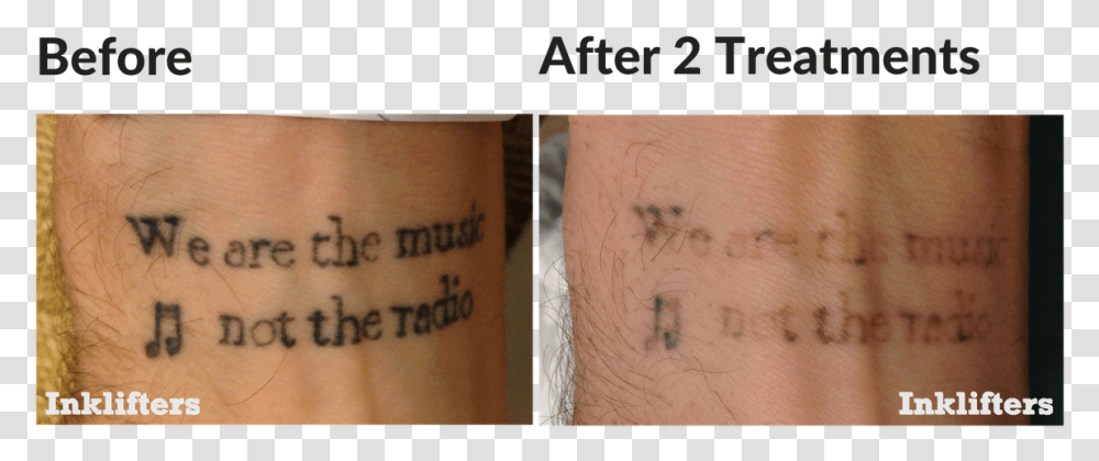 Second Treatment Laser Tattoo Removal, Skin, Face, Arm Transparent Png
