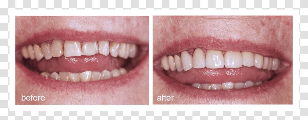 Shot Of Before And After Visiting Abington Smile Gallery Mouth, Teeth, Lip, Jaw, Person Transparent Png