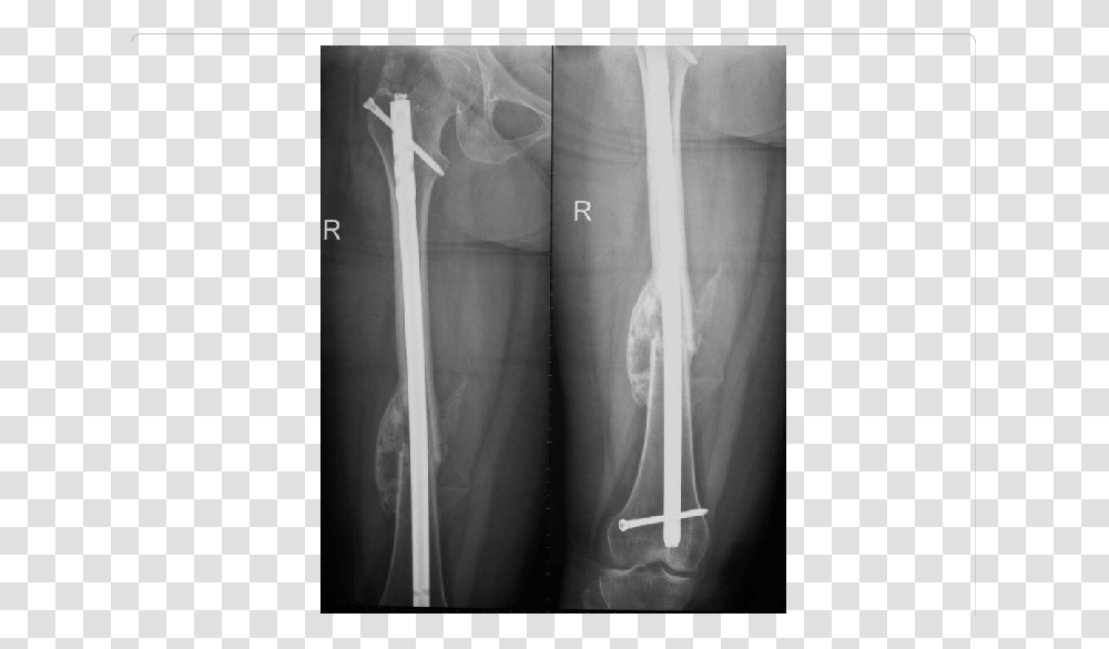 Showing X Ray Of Femur With Accelerated Fracture Healing Healed Femur X Ray, X-Ray, Medical Imaging X-Ray Film Transparent Png
