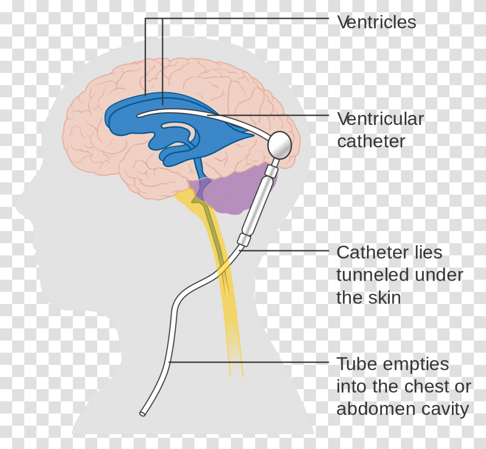 Shunt In Spine Cervical, Head, Neck, Plot, Diagram Transparent Png
