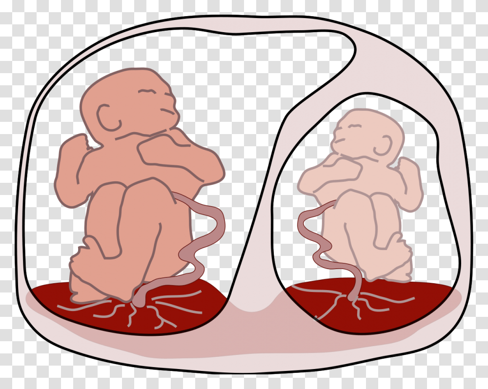 Sindrome De Transfusion Intergemelar, Baby, Cupid, Newborn Transparent Png