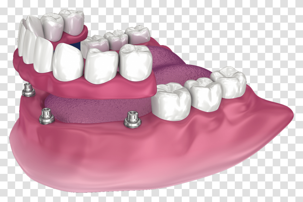 Snap On Dentures In San Diego Full Denture With Precision Attachments, Teeth, Mouth, Lip, Jaw Transparent Png