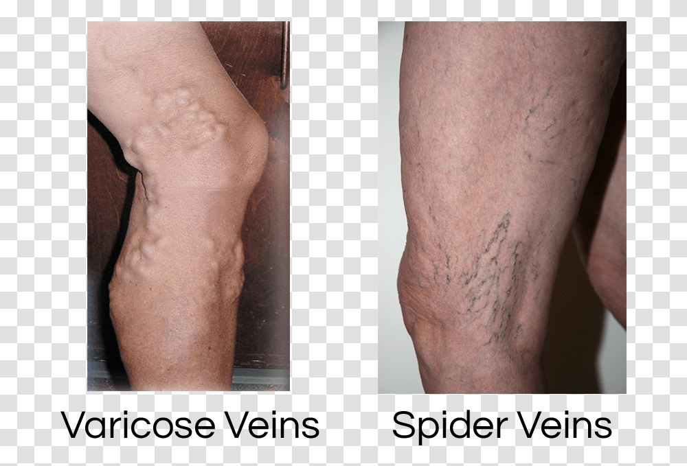 Spider Veins, Person, Human, Knee, Arm Transparent Png