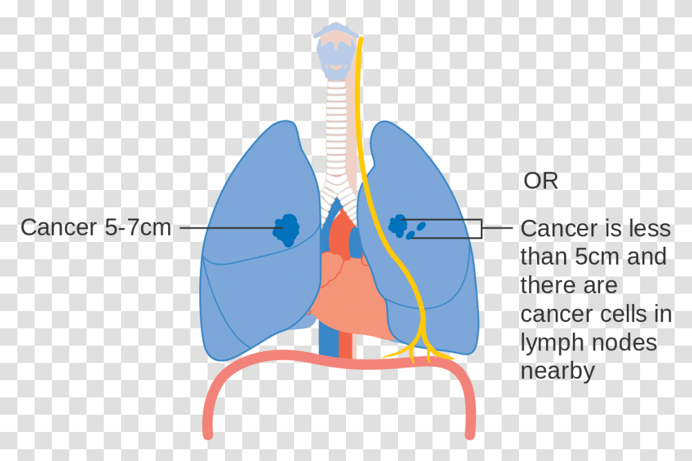 Stage 1 Early Stage Lung Cancer, Diagram, Plot Transparent Png