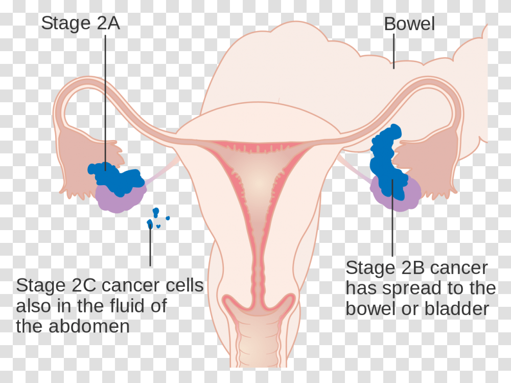 Stage 1 Ovarian Cancer Staging, Shoulder, Diagram, Neck Transparent Png