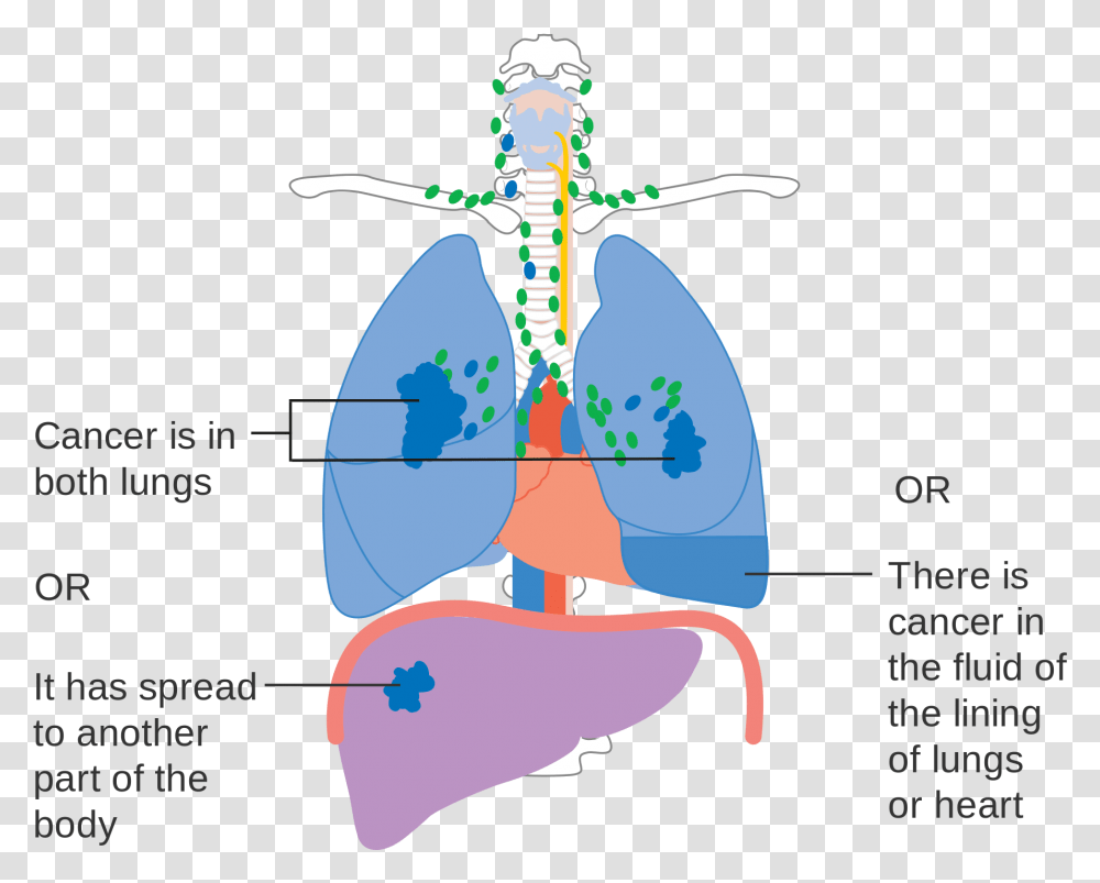 Stage 4 Lung Cancer Diagram, Cross, Plot, X-Ray Transparent Png