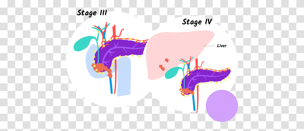 Stages Of Pancreatic Cancer Pancreatic Cancer Stafe 4, Purple, Ear, Head, Mouth Transparent Png