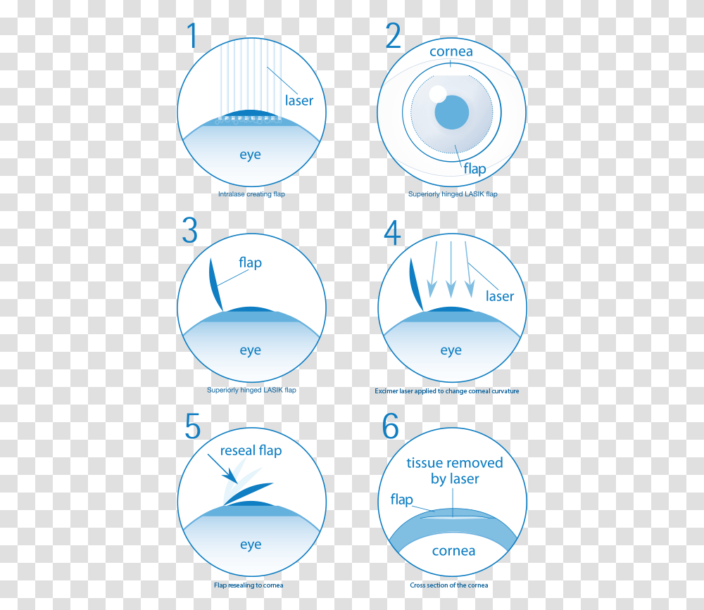 Steps Lasik Eye Surgery, Diagram, Plot, Sphere, Number Transparent Png