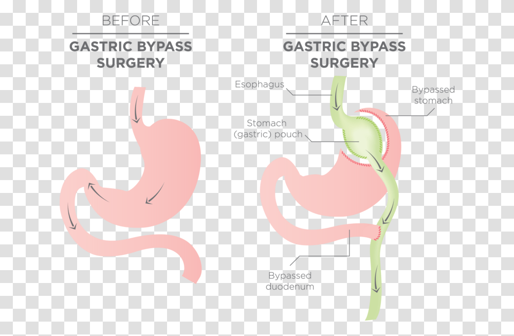 Stomach Before And After Gastric Bypass, Poster, Advertisement Transparent Png