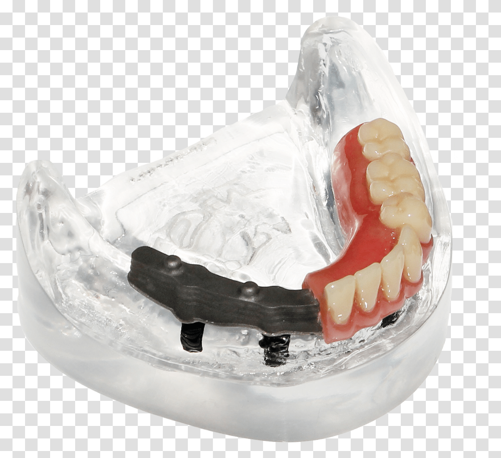 Supra Solution Bar Denture Photo Tongue, Teeth, Mouth, Lip, Jaw Transparent Png