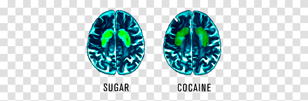 Sweet Tooth Foggy Brain - Russell Boon Sugar Affects Your Brain, X-Ray, Ct Scan, Medical Imaging X-Ray Film, Plectrum Transparent Png