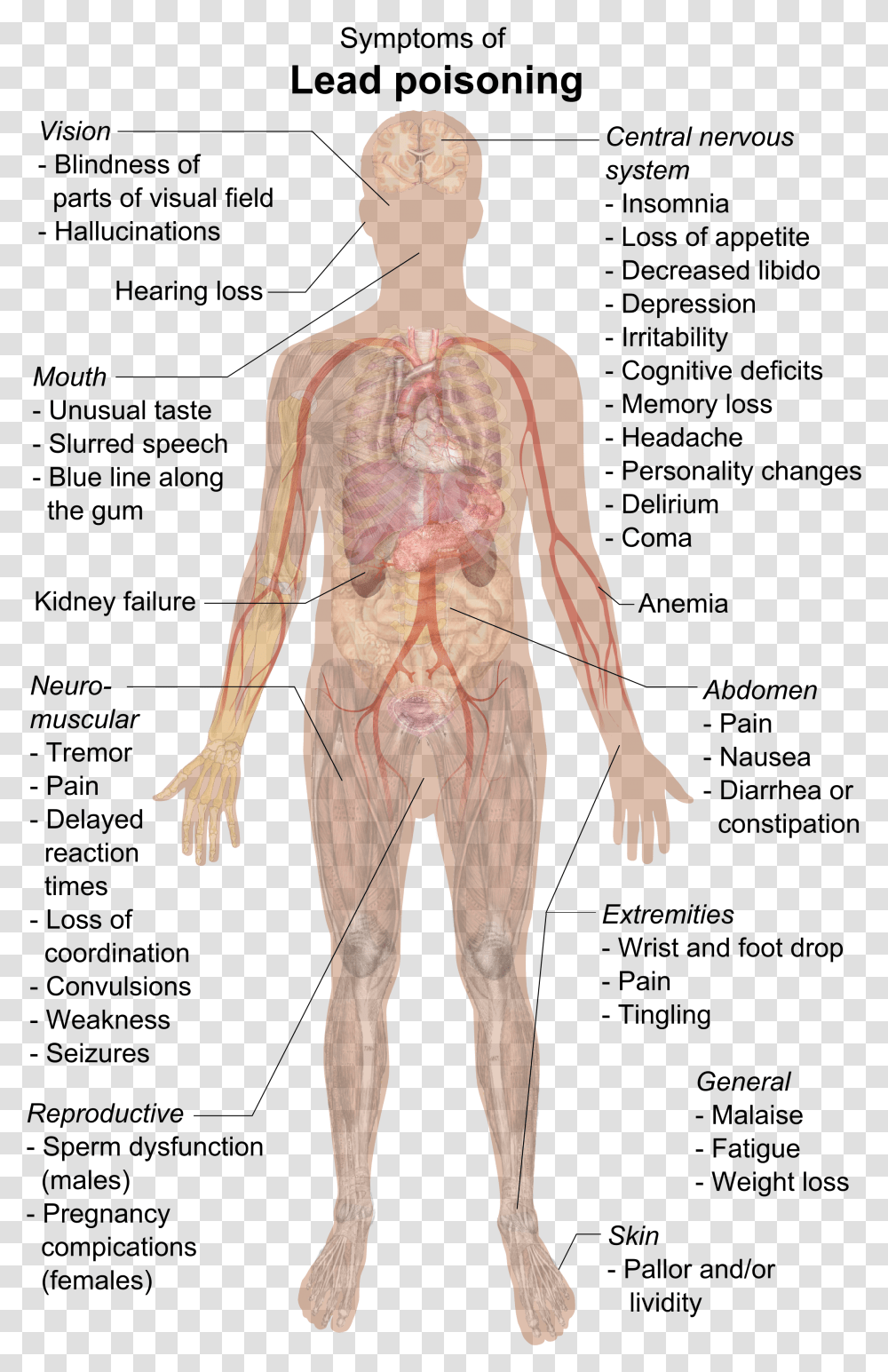Symptoms Of Lead Poisoning Lead Poisoning Symptoms, Person, Human, Torso, Alien Transparent Png