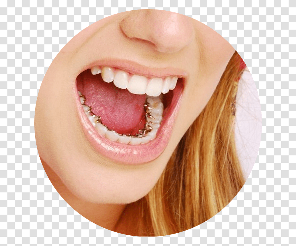 Teeth Inside Braces, Mouth, Lip, Person, Human Transparent Png