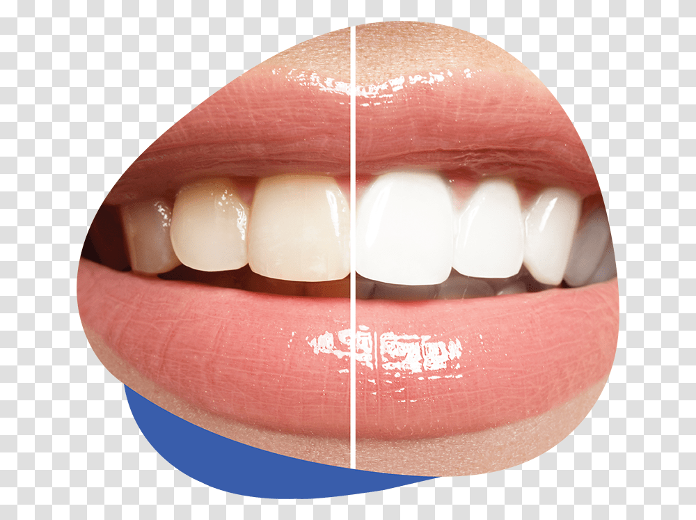 Teeth Whitening Ranking Past Do Zbw Wybielajcych, Mouth, Lip, Egg, Food Transparent Png