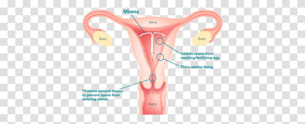 The Egg Girl Auf Twitter What Is An Iud Iud Birth Control, Blow Dryer, Appliance, Hair Drier, Diagram Transparent Png