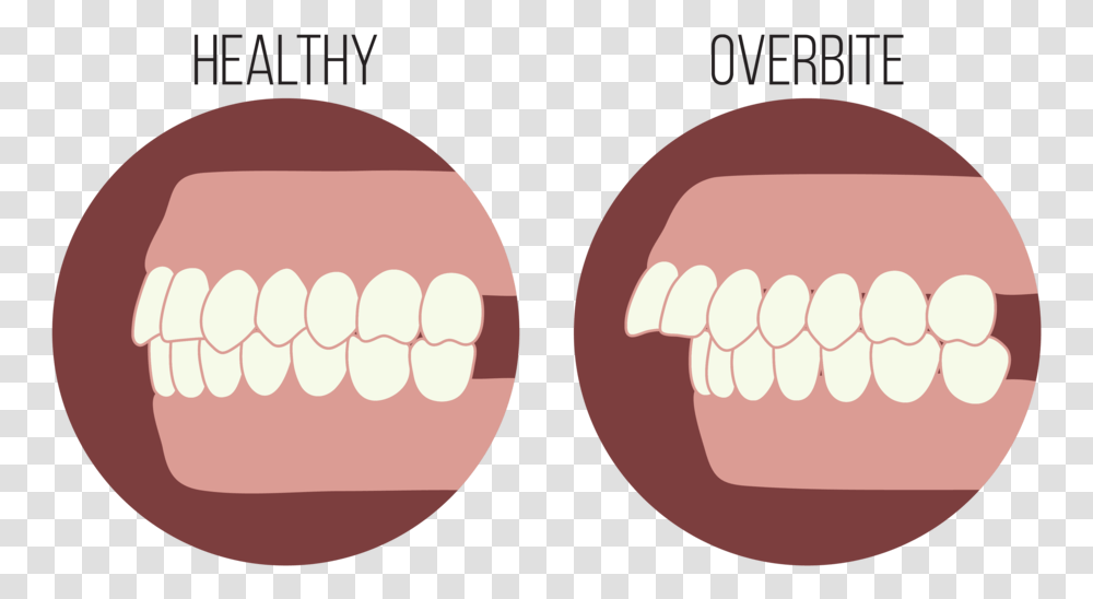 The Steps To Overbite, Teeth, Mouth, Lip, Hand Transparent Png