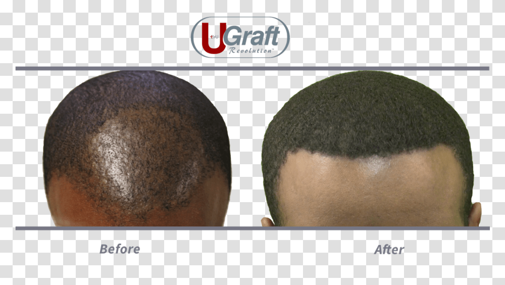 This Patient Benefited From 1400 Grafts Safely Extracted Buzz Cut, Hair, Head, Person, Human Transparent Png