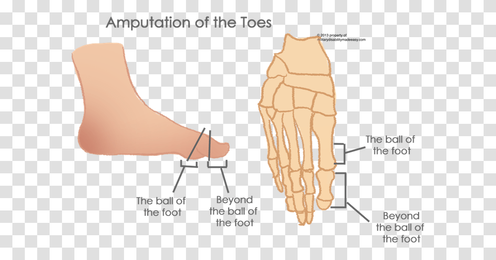 Toes Partial Amputation Of Toe, Plot, Hand, Diagram, Injection Transparent Png