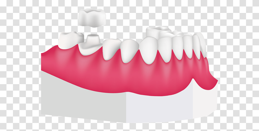 Tooth Clipart Crown Clipart Royalty Free Stock Dental, Teeth, Mouth, Jaw, Balloon Transparent Png