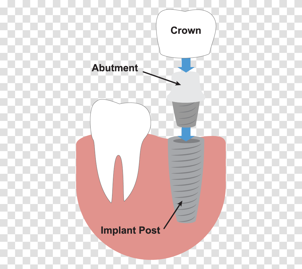 Tooth Outline Dental Implant Illustration, Injection, Toothpaste Transparent Png