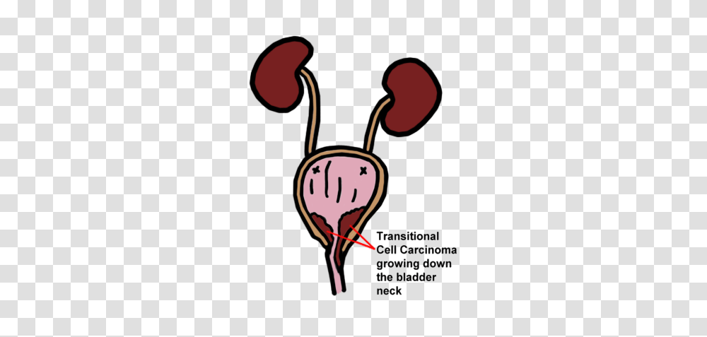Transitional Cell Carcinoma, Dynamite, Bomb, Weapon, Weaponry Transparent Png