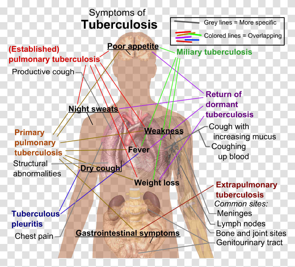Tuberculosis Symptoms Tuberculosis Tests, Plot, Diagram, Person, Human Transparent Png