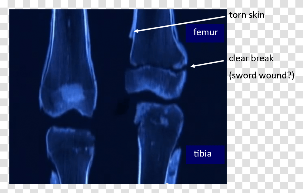 Tut S Leg Bones Radiography, X-Ray, Ct Scan, Medical Imaging X-Ray Film, Person Transparent Png