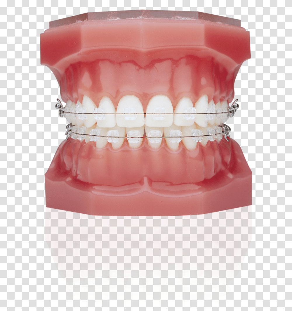 Typodont With Braces, Jaw, Teeth, Mouth, Lip Transparent Png
