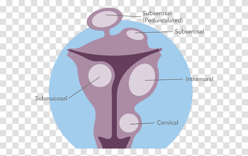 Uterine Fibroid Articles Illustration, Hip, Sphere Transparent Png