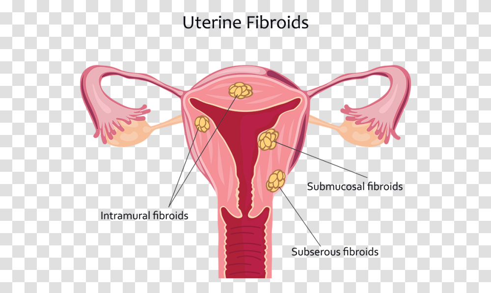 Uterine Fibroids Uterine Fibroid, Hand, Shoulder, Cupid Transparent Png