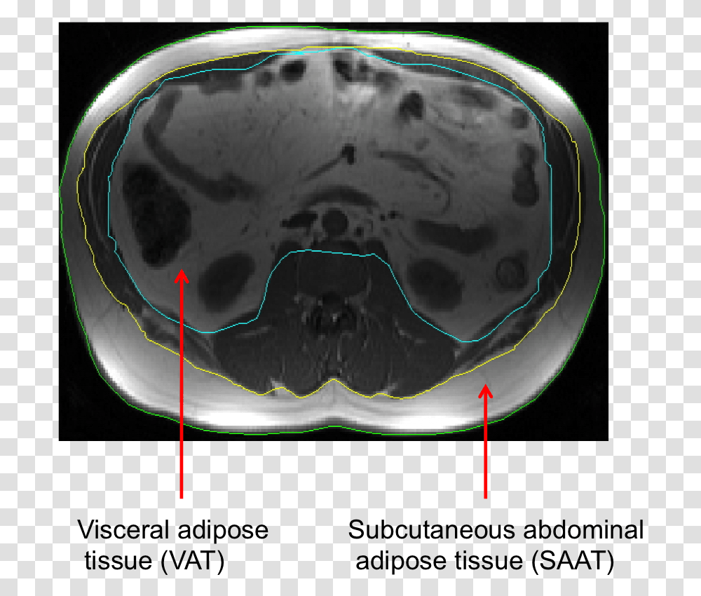V Fat Computed Tomography, Helmet, Apparel, X-Ray Transparent Png