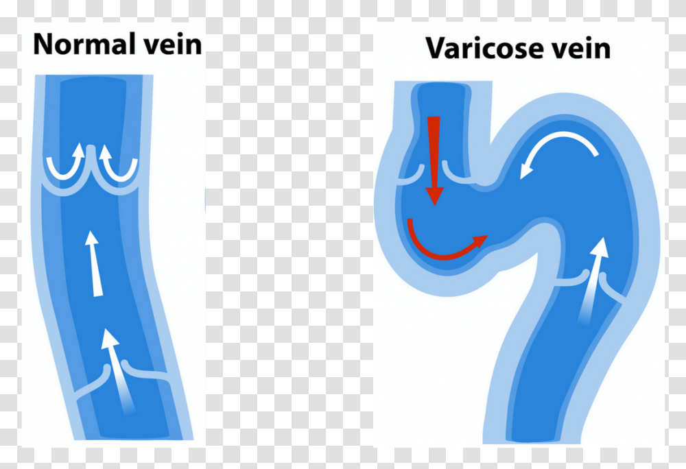 Varicose Vein Symptoms Normal Vein Vs Varicose Vein, Label, Number Transparent Png