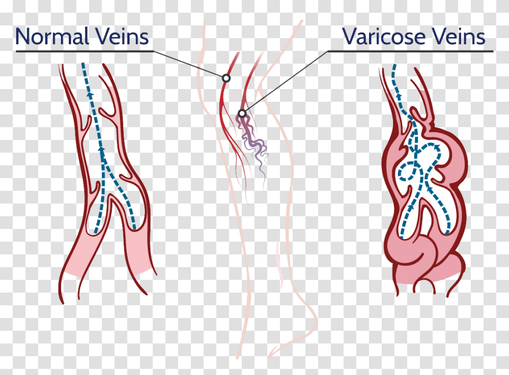 Veins Varicose Vein Pencil Diagram, Bow, Leisure Activities, Skeleton, Plot Transparent Png