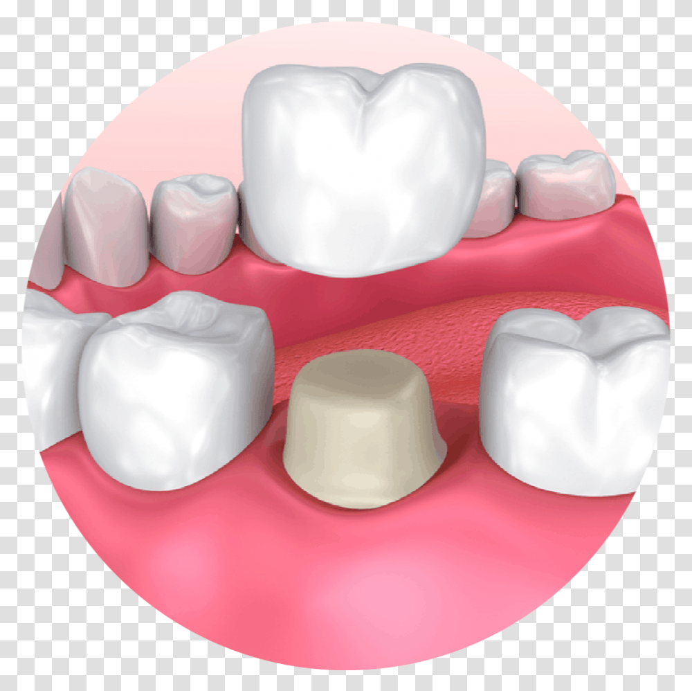 What Is A Dental Crown Dental Crown, Pillow, Cushion, Sweets, Food Transparent Png